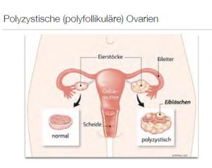 polyzystisches Ovar